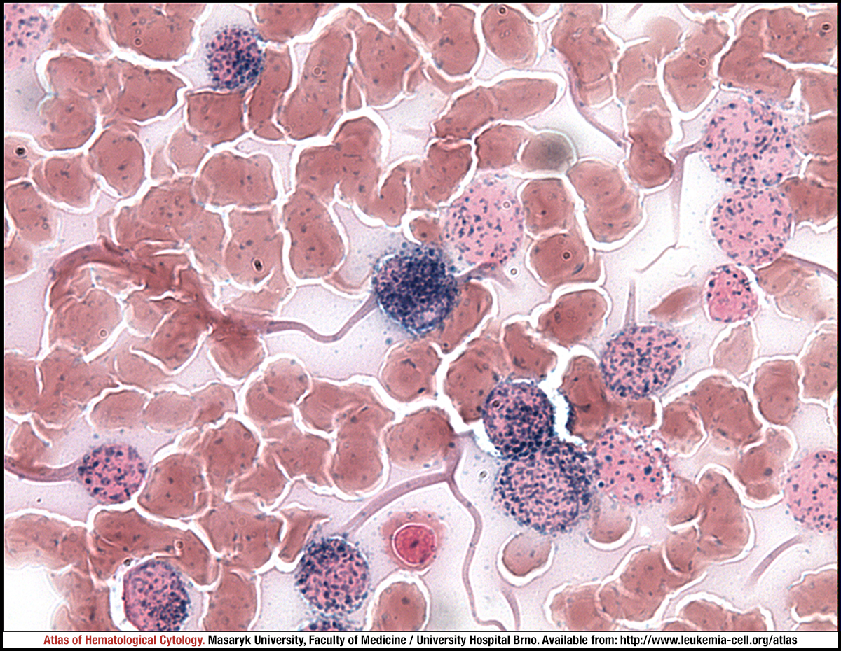Acute monoblastic/monocytic leukaemia - CELL - Atlas of Haematological ...
