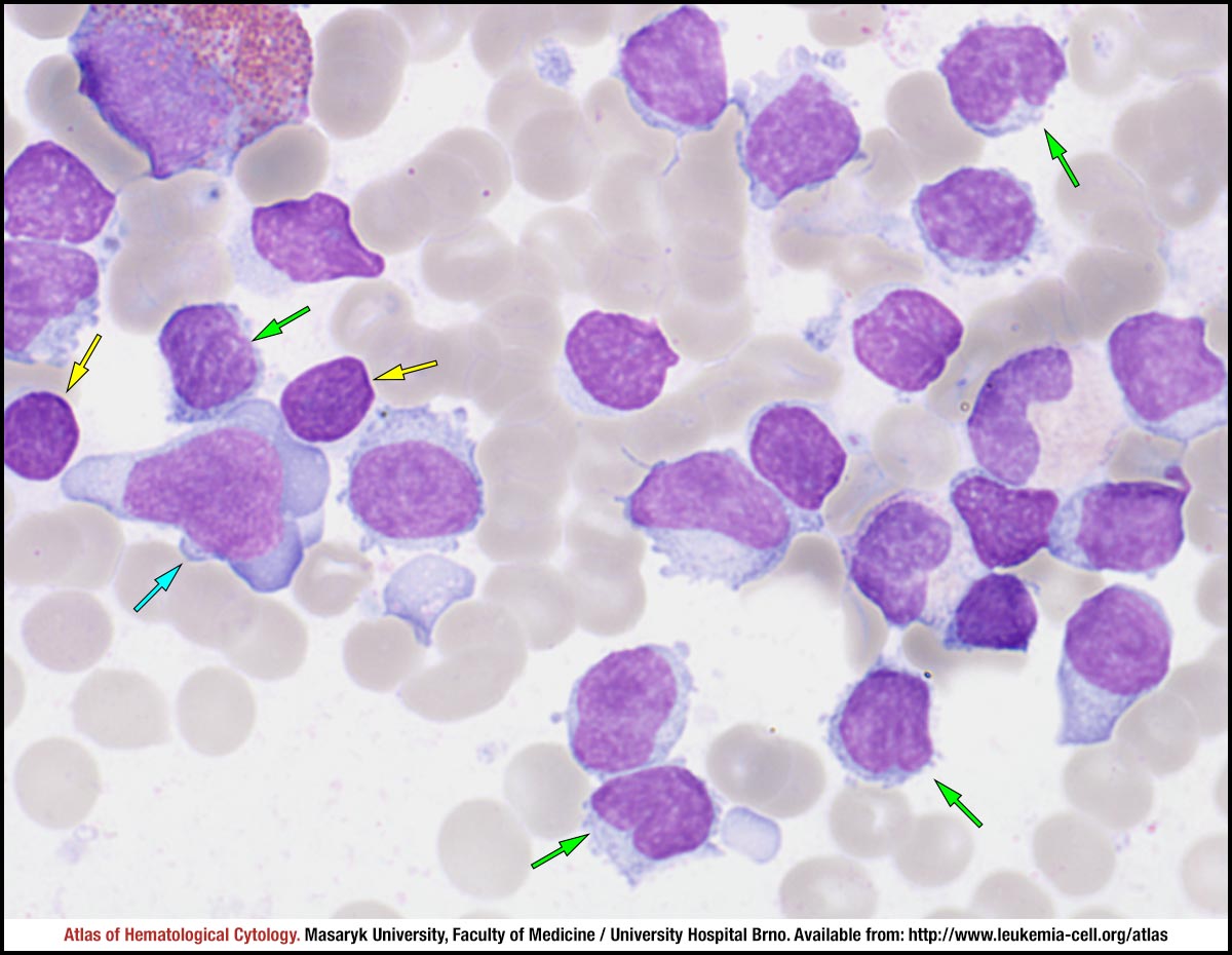 Chronic Lymphocytic Leukaemia Atypical Pleomorphic Variant