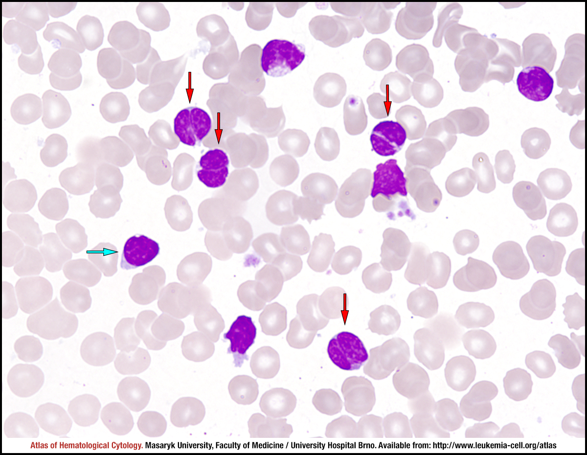 Follicular lymphoma - CELL - Atlas of Haematological Cytology
