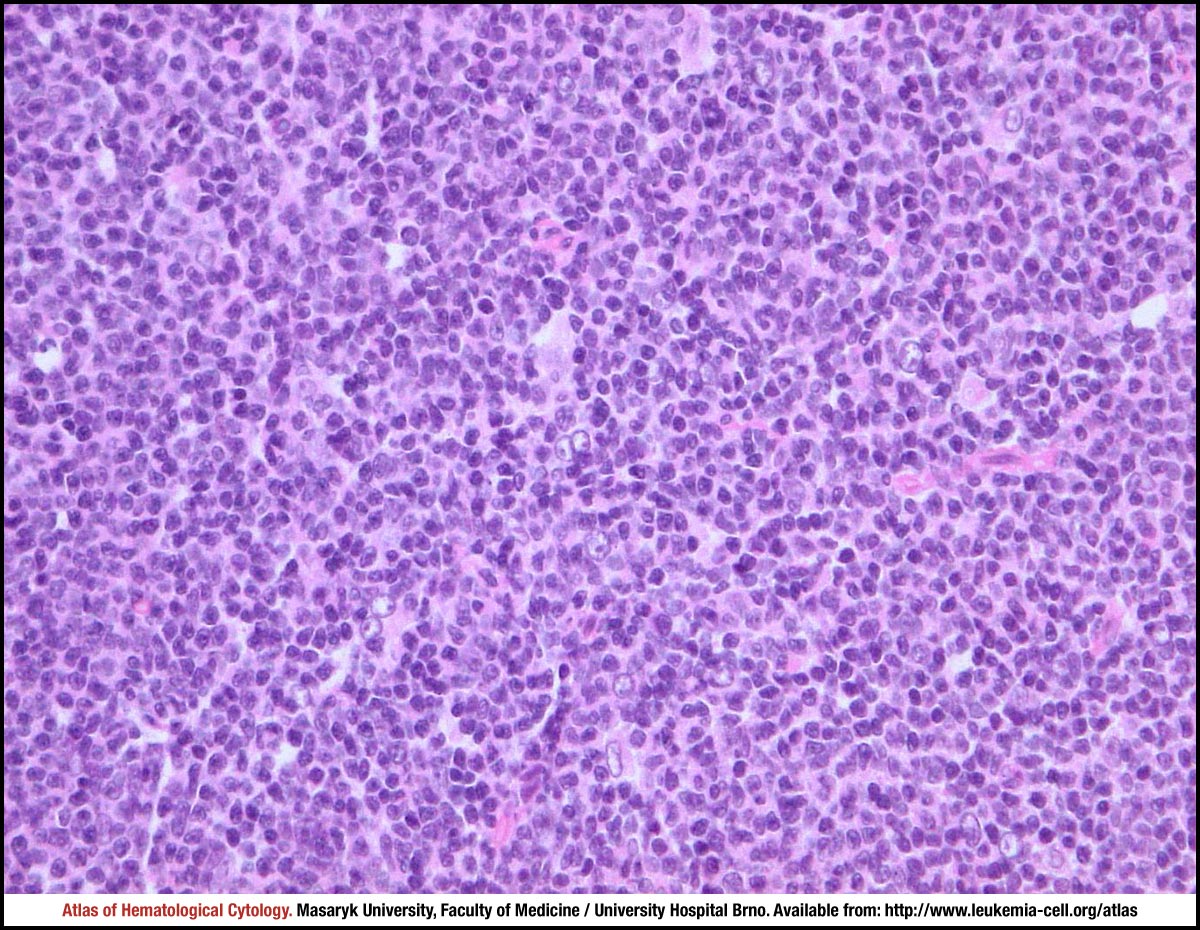 Follicular lymphoma - CELL - Atlas of Haematological Cytology
