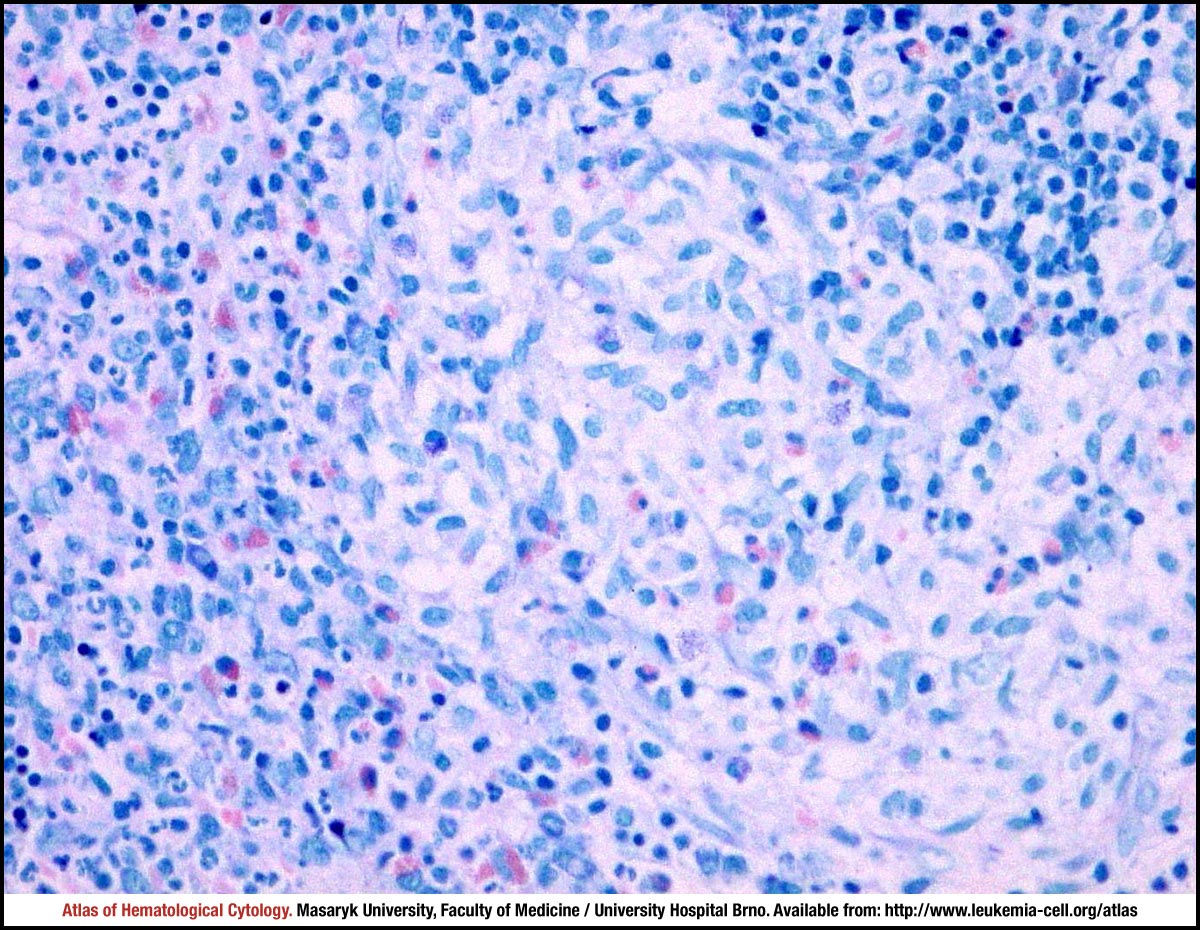 Systemic Mastocytosis CELL Atlas Of Haematological Cytology