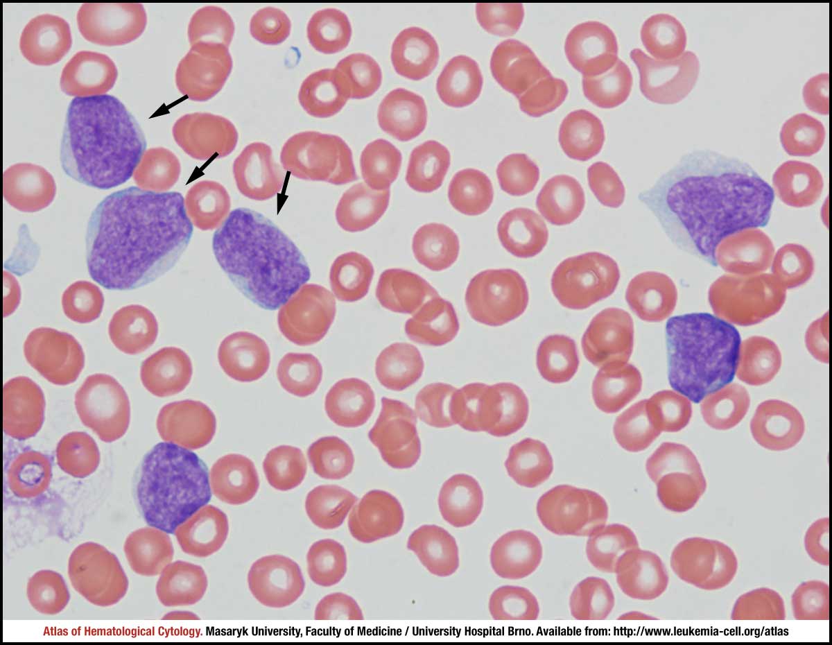 Blastoid variant CELL Atlas of Haematological Cytology