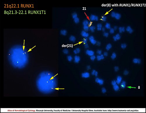 Fluorescence in situ hybridisation (FISH) of ''RUNX1-RUNX1T1'' fusion