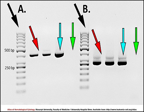 Agarose gel electropherogram for ''RUNX-RUNX1T1'' transcript detection