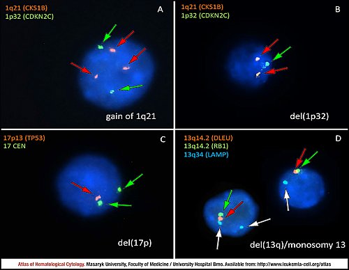 Fluorescence in situ hybridisation (FISH) of genomic imbalance in plasma cell myeloma