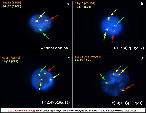 Fluorescence in situ hybridisation (FISH) of ''IGH'' translocations in plasma cell myeloma