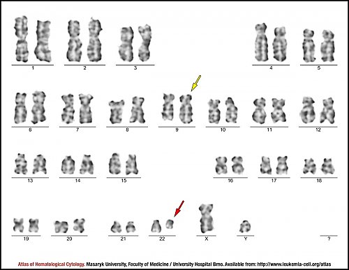 G-banded male karyotype with t(9;22)(q34;q11.2)