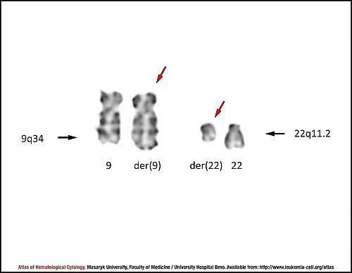 G-banded partial karyotype of translocation t(9;22)(q34;q11.2)