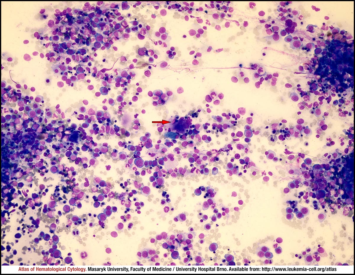 Vitamin B12 deficiency CELL Atlas of Haematological Cytology