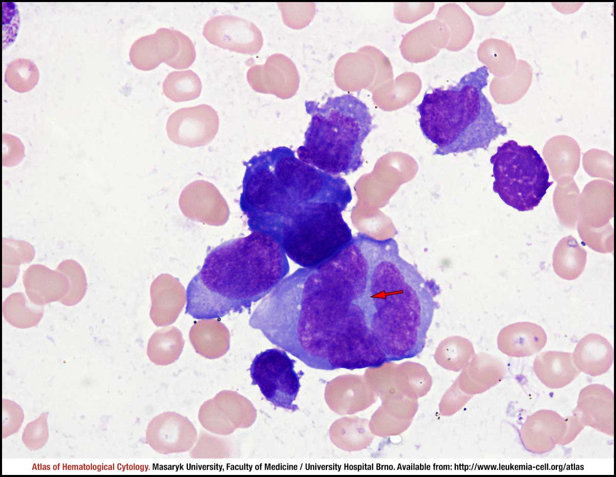 Plasma cell myeloma CELL Atlas of Haematological Cytology