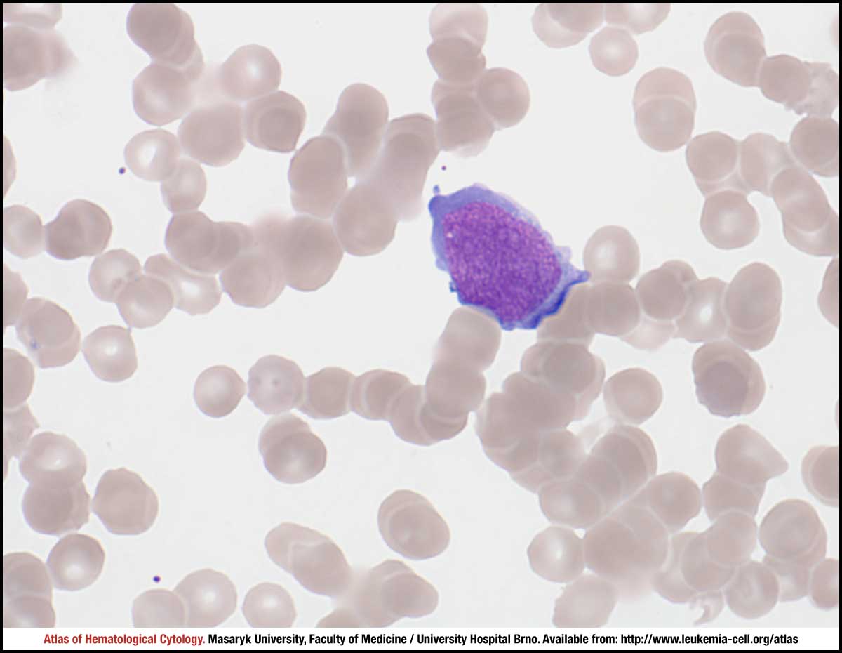 Anaplastic Large Cell Lymphoma Alk Positive Cell Atlas Of