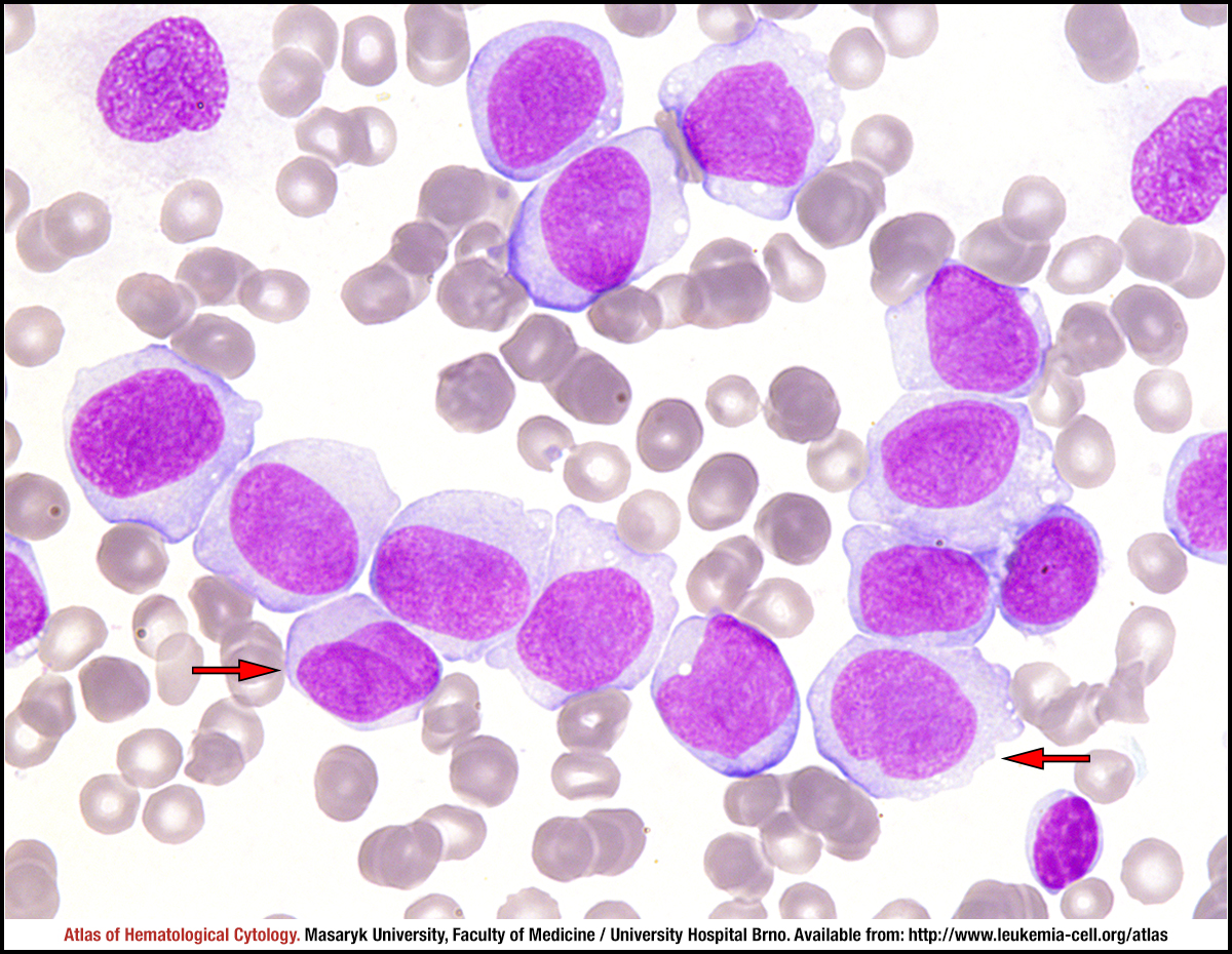 Acute monoblastic/monocytic leukaemia - CELL - Atlas of ...