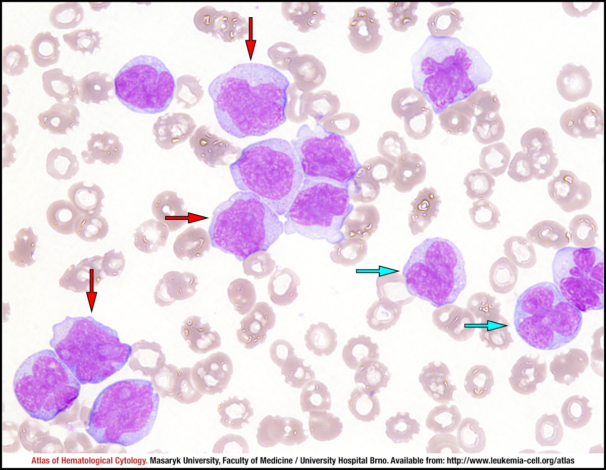 Acute monoblastic/monocytic leukaemia - CELL - Atlas of ...