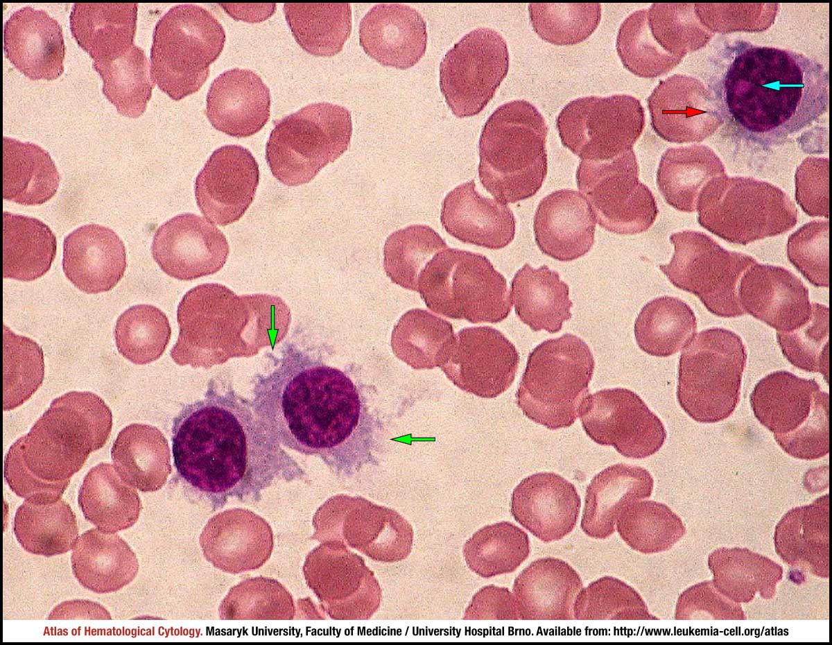 Splenic Marginal Zone Lymphoma