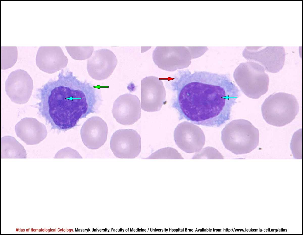 Splenic Marginal Zone Lymphoma