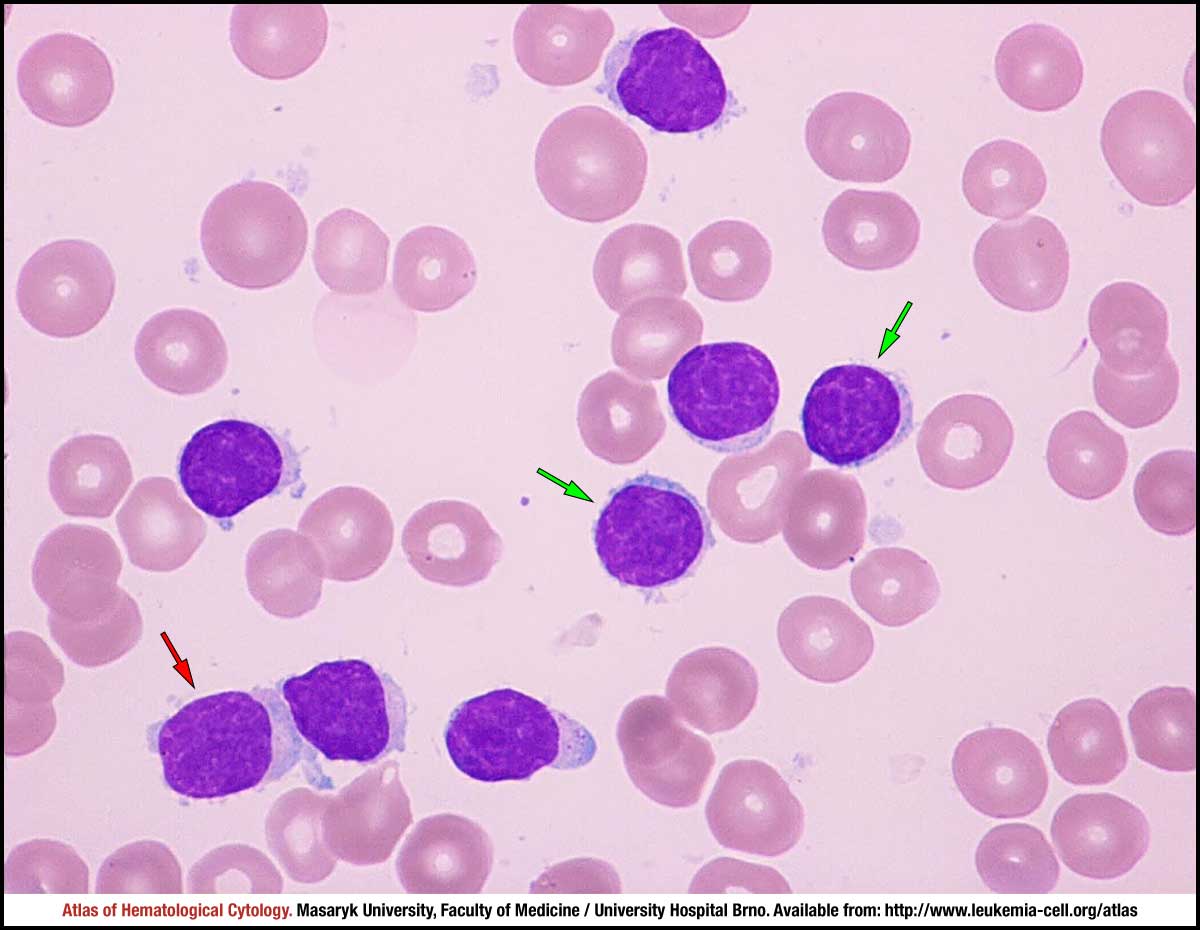 Waldenström Macroglobulinaemia Cell Atlas Of Haematological Cytology