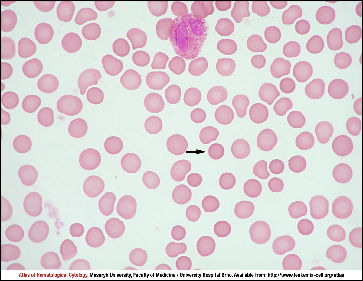 Hereditary Spherocytosis Blood Smear