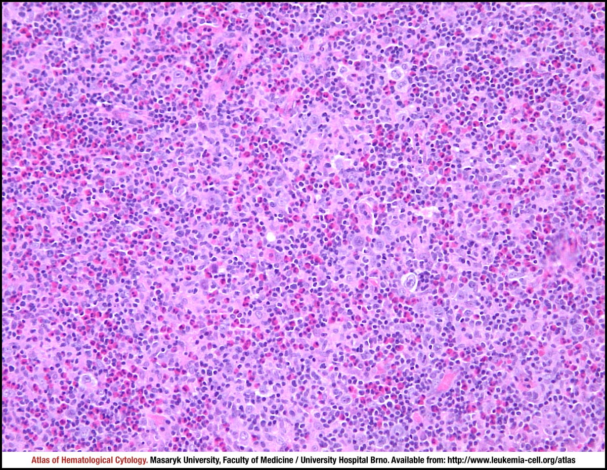 Mixed Cellularity Classic Hodgkin Lymphoma Cell Atlas Of