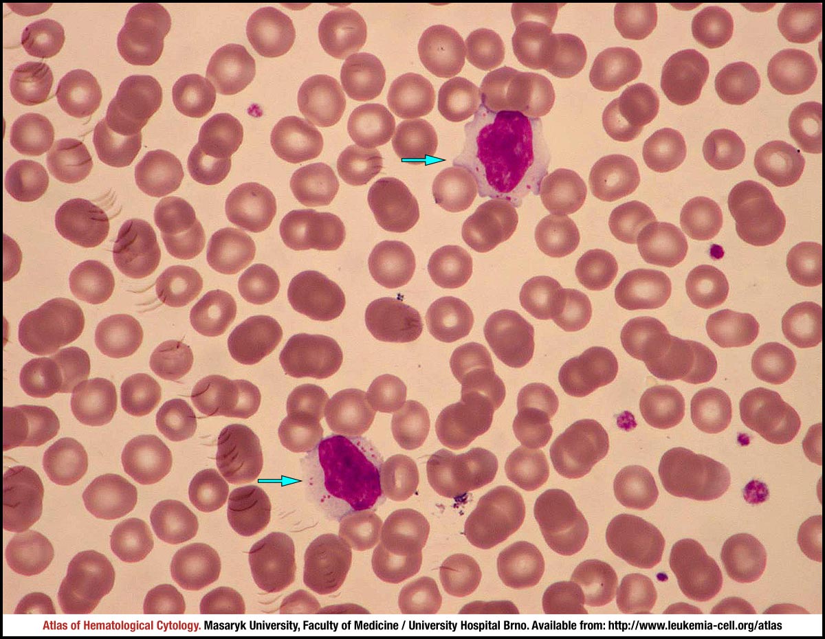 icd 10 cm code for t cell large granular lymphocytic leukemia
