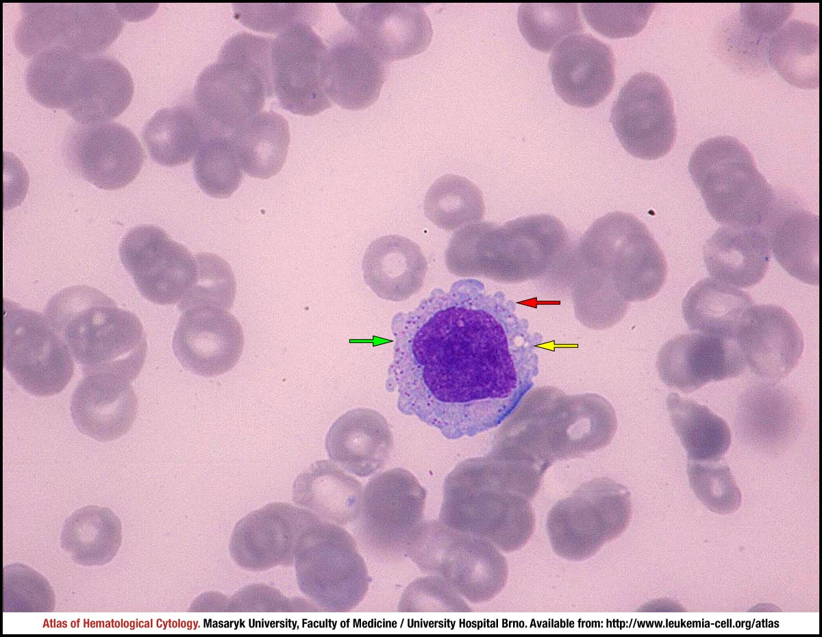 Hepatosplenic T Cell Lymphoma Cell Atlas Of Haematological Cytology