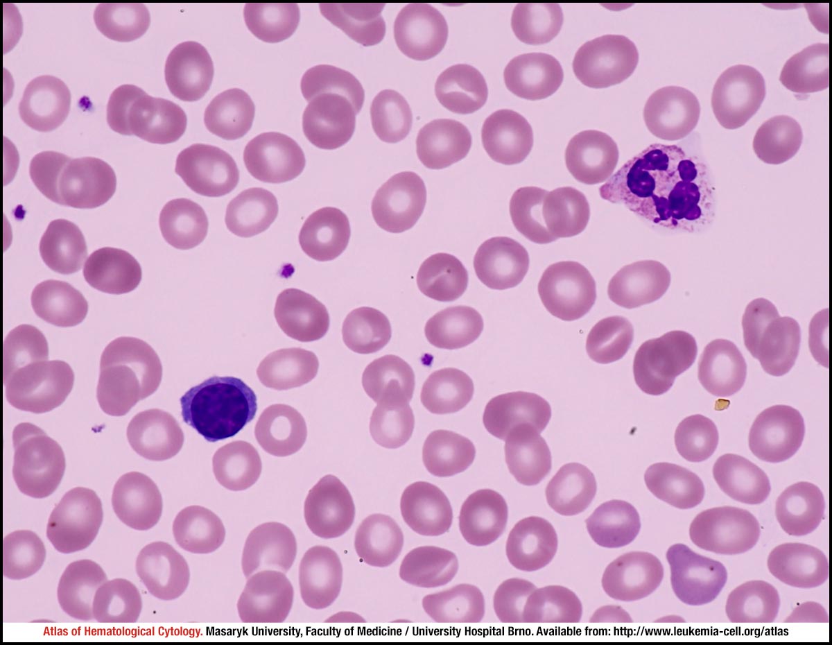 living with paroxysmal nocturnal dyspnea living with paroxysmal nocturnal dyspnea
