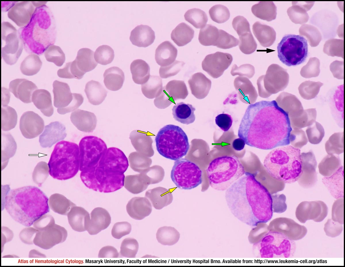 paroxysmal-nocturnal-haemoglobinuria-cell-atlas-of-haematological