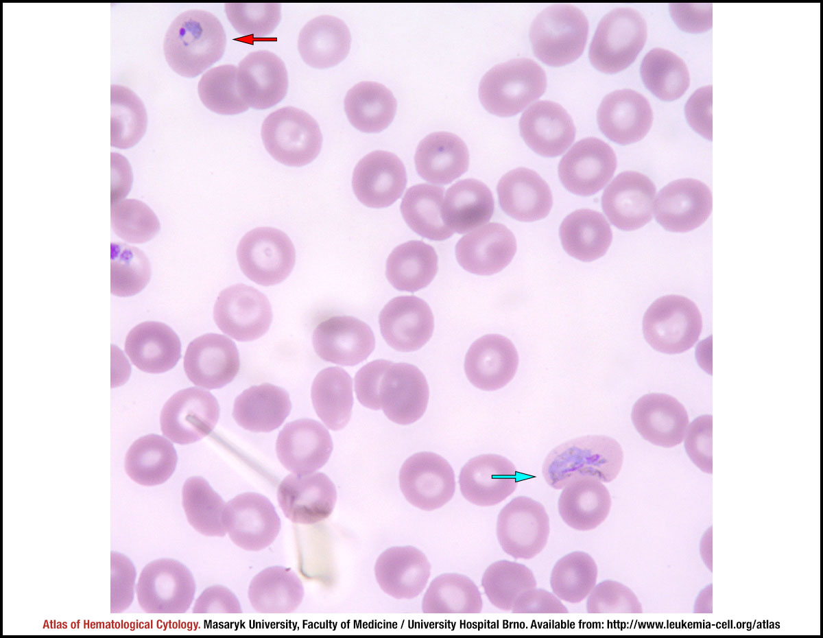 SOLUTION: Malaria picture 2 - Studypool