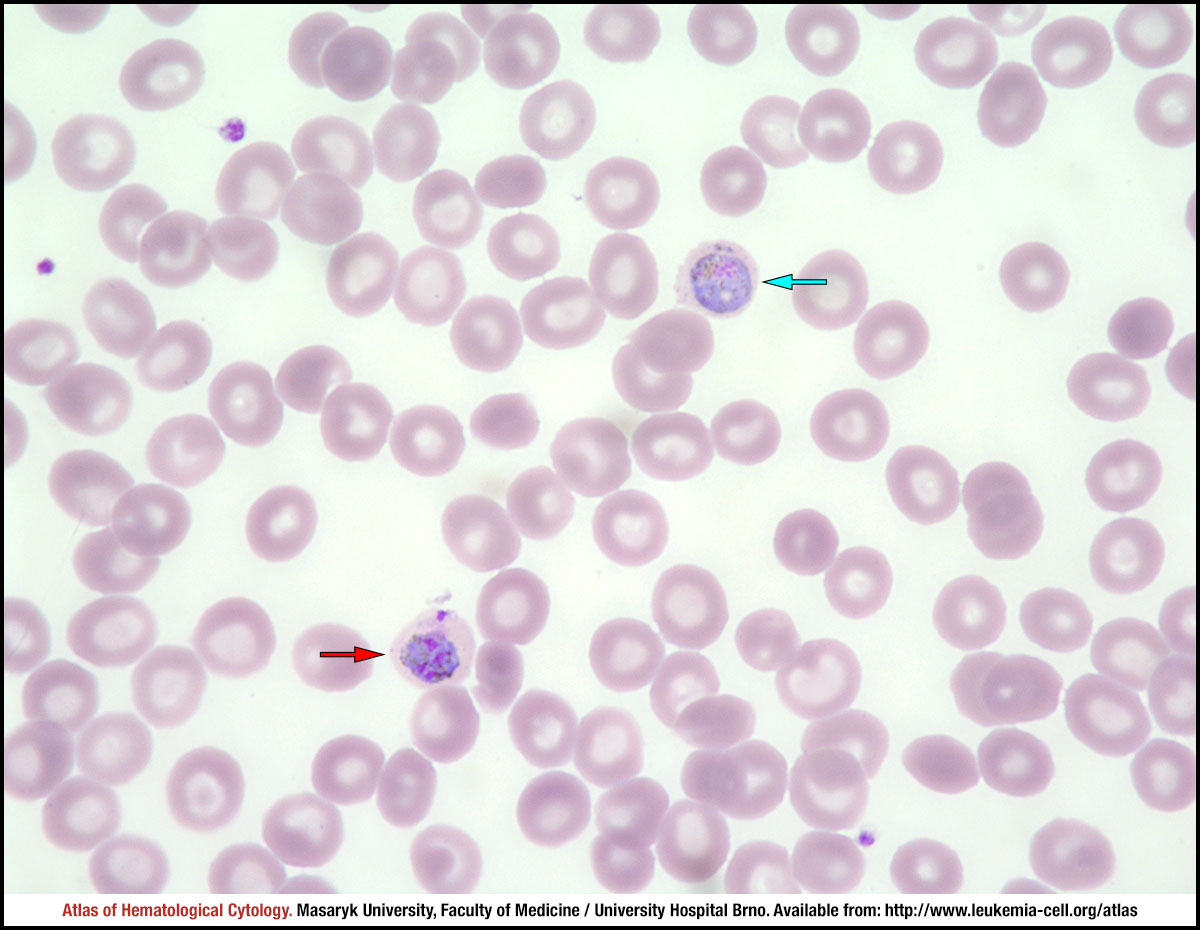 Malaria | Causes, Symptoms, Treatment, & Prevention | Britannica