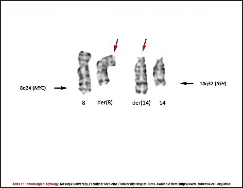 G-banded partial karyotype of translocation t(8;14)(q24;q32)