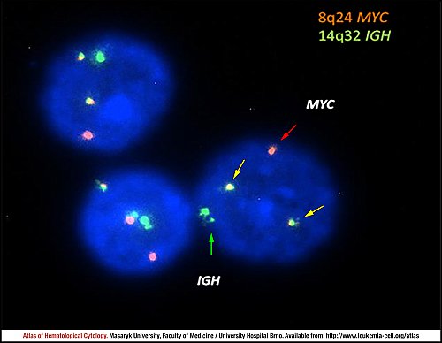 Fluorescence in situ hybridisation (FISH) of ''IGH-MYC'' fusion