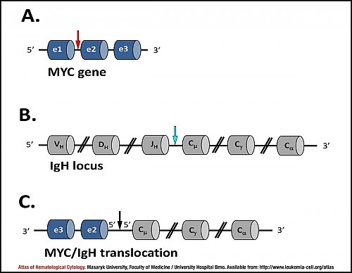 Schematic representation of t(8;14)(q24;q32) ''MYC/IGH'' translocation in sporadic Burkitt lymphoma