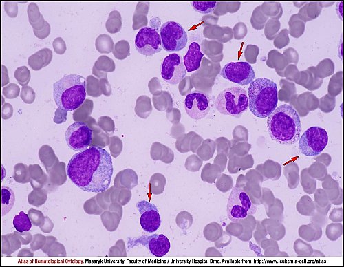 Chronic myelomonocytic leukemia treatment