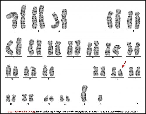 G-banded male karyotype with del(17p)