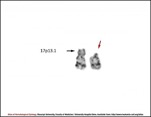 G-banded partial karyotype of del(17p)