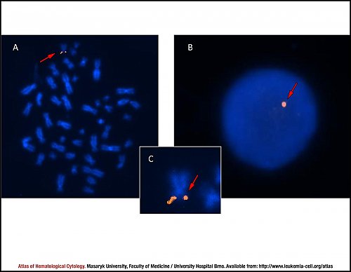 Fluorescence in situ hybridisation (FISH) of del(17p)