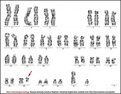 G-banded male karyotype of 20q deletion
