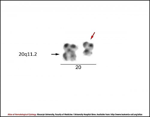 G-banded partial karyotype of del(20)(q11.2)