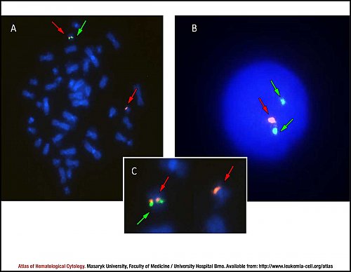 Fluorescence in situ hybridisation (FISH) of 20q12 deletion