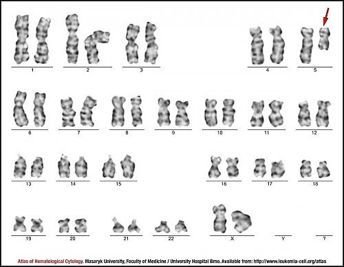 G-banded female karyotype of del(5)(q13q33)
