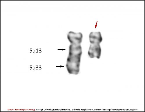 G-banded partial karyotype of del(5)(q13q33)