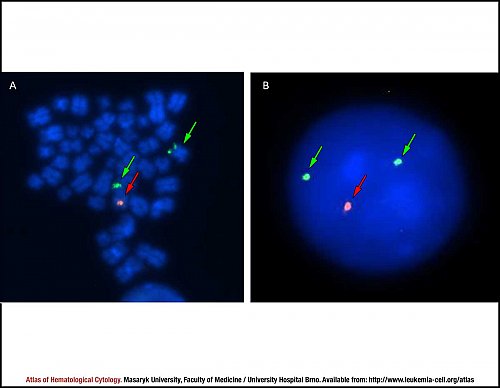 Fluorescence in situ hybridisation (FISH) of deletion 5q31.2