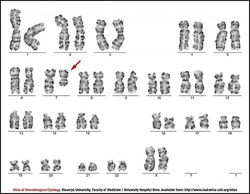 G-banded female karyotype of del(7)(q22q34)