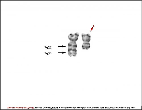 G-banded partial karyotype of del(7)(q22q34)