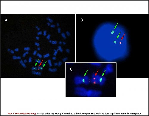 Fluorescence in situ hybridisation (FISH) of 7q31 deletion