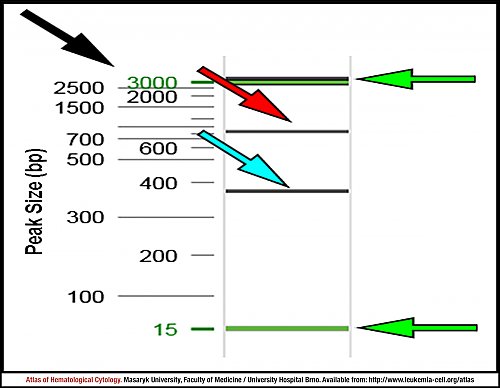 Electropherogram for ''BCR-ABL1'' transcript detection after Multiplex RT-PCR