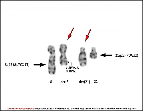 G-banded partial karyotype of translocation t(8;21)(q22;q22)