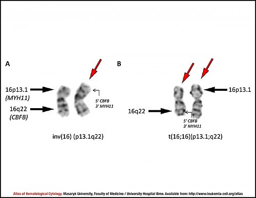 G-banded partial karyotype of inversion inv(16)(p13.1q22) and translocation  t(16;16)(p13.1;q22)