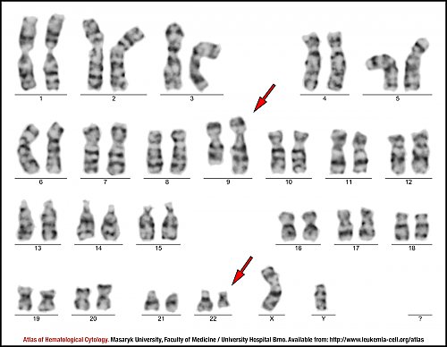 G-banded male karyotype of t(9;22)(q34;q11.2)