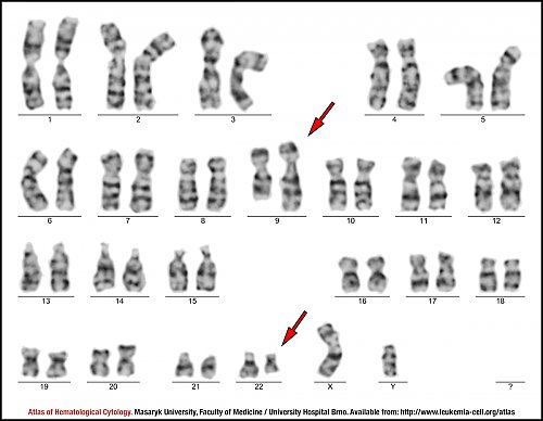 G-banded male karyotype of t(9;22)(q34;q11.2)