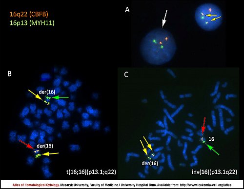Fluorescence in situ hybridisation (FISH) of ''CBFB-MYH11'' fusion